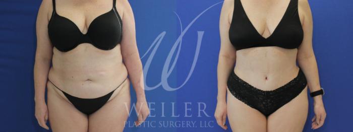 Before & After Tummy Tuck Case 916 Front View in Baton Rouge, New Orleans, & Lafayette, Louisiana