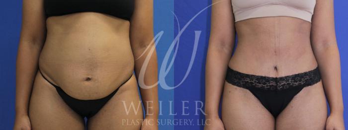 Before & After Tummy Tuck Case 917 Front View in Baton Rouge, New Orleans, & Lafayette, Louisiana