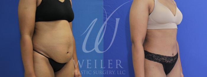 Before & After Tummy Tuck Case 917 Right Oblique View in Baton Rouge, New Orleans, & Lafayette, Louisiana