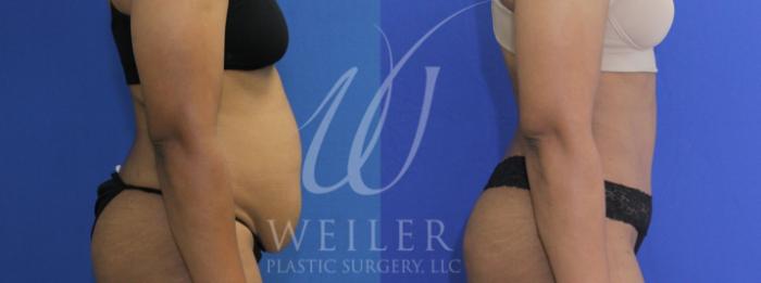 Before & After Tummy Tuck Case 917 Right Side View in Baton Rouge, New Orleans, & Lafayette, Louisiana