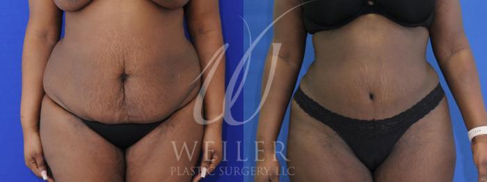 Before & After Tummy Tuck Case 923 Front View in Baton Rouge, Louisiana