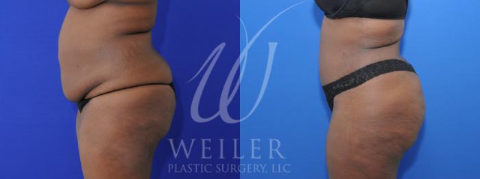 Before & After Tummy Tuck Case 923 Left Side View in Baton Rouge, Louisiana
