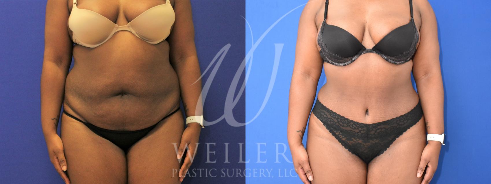 Before & After Tummy Tuck Case 928 Front View in Baton Rouge, Louisiana