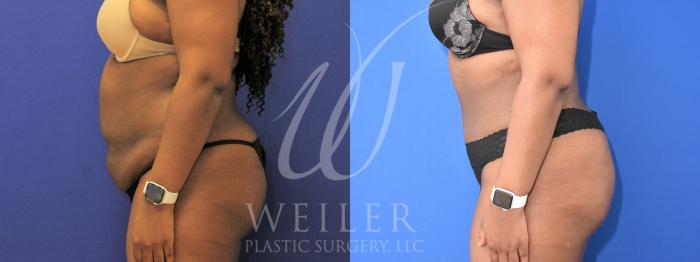 Before & After Tummy Tuck Case 928 Left Side View in Baton Rouge, New Orleans, & Lafayette, Louisiana