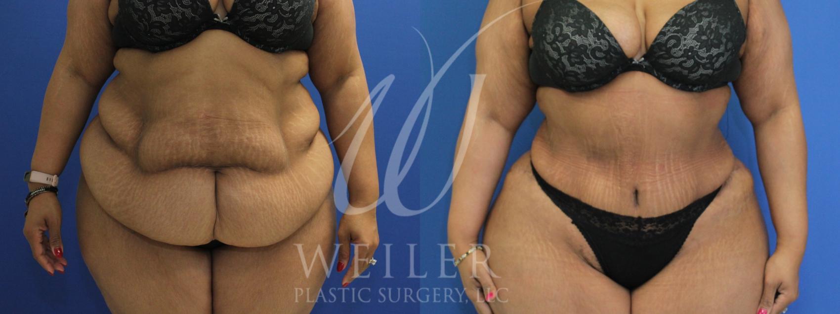 Before & After Tummy Tuck Case 936 Front View in Baton Rouge, Louisiana