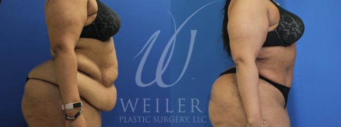 Before & After Tummy Tuck Case 936 Right Side View in Baton Rouge, Louisiana