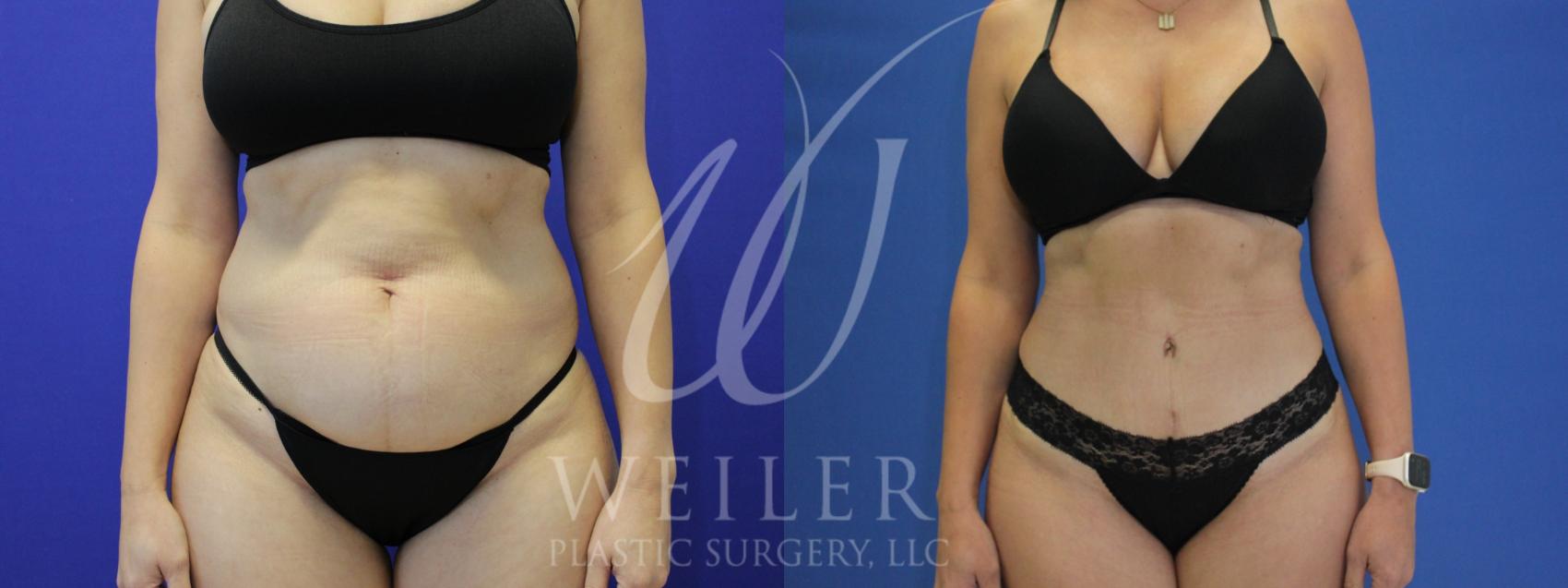 Before & After Tummy Tuck Case 954 Front View in Baton Rouge, New Orleans, & Lafayette, Louisiana