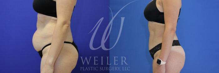 Before & After Tummy Tuck Case 954 Left Side View in Baton Rouge, New Orleans, & Lafayette, Louisiana