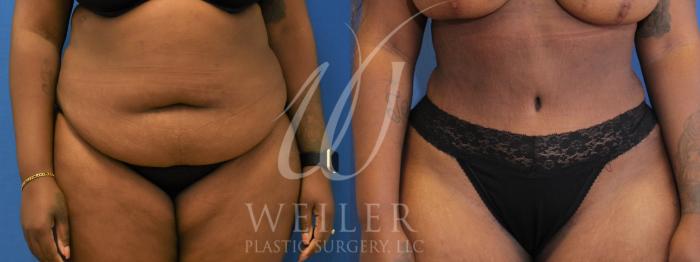 Before & After Tummy Tuck Case 958 Front View in Baton Rouge, New Orleans, & Lafayette, Louisiana