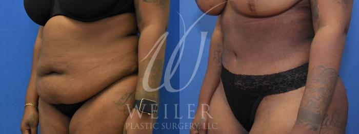 Before & After Tummy Tuck Case 958 Left Oblique View in Baton Rouge, New Orleans, & Lafayette, Louisiana