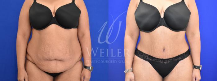 Before & After Tummy Tuck Case 959 Front View in Baton Rouge, New Orleans, & Lafayette, Louisiana
