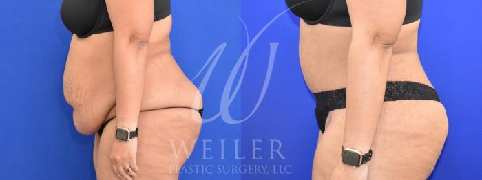 Before & After Tummy Tuck Case 959 Left Side View in Baton Rouge, New Orleans, & Lafayette, Louisiana