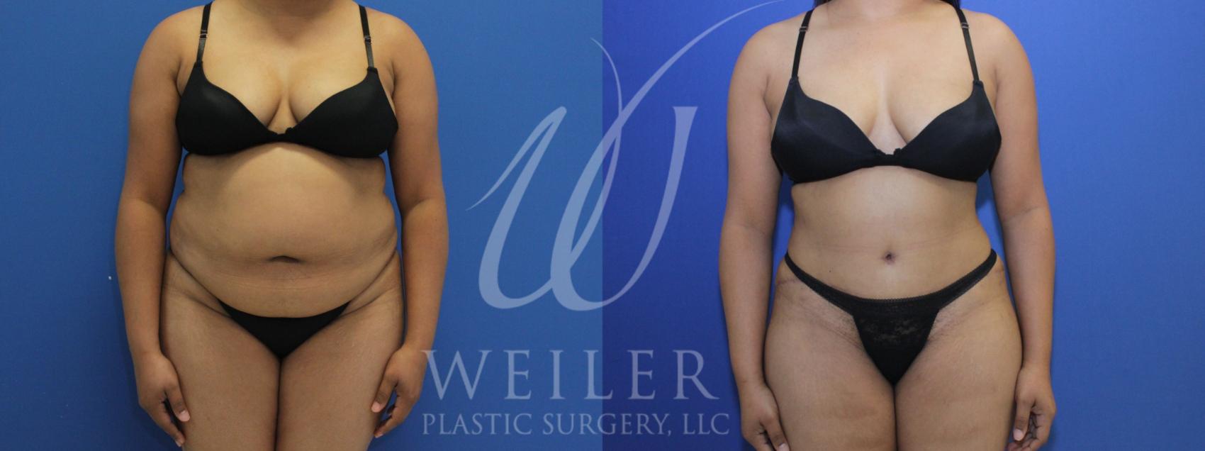 Before & After Tummy Tuck Case 960 Front View in Baton Rouge, New Orleans, & Lafayette, Louisiana