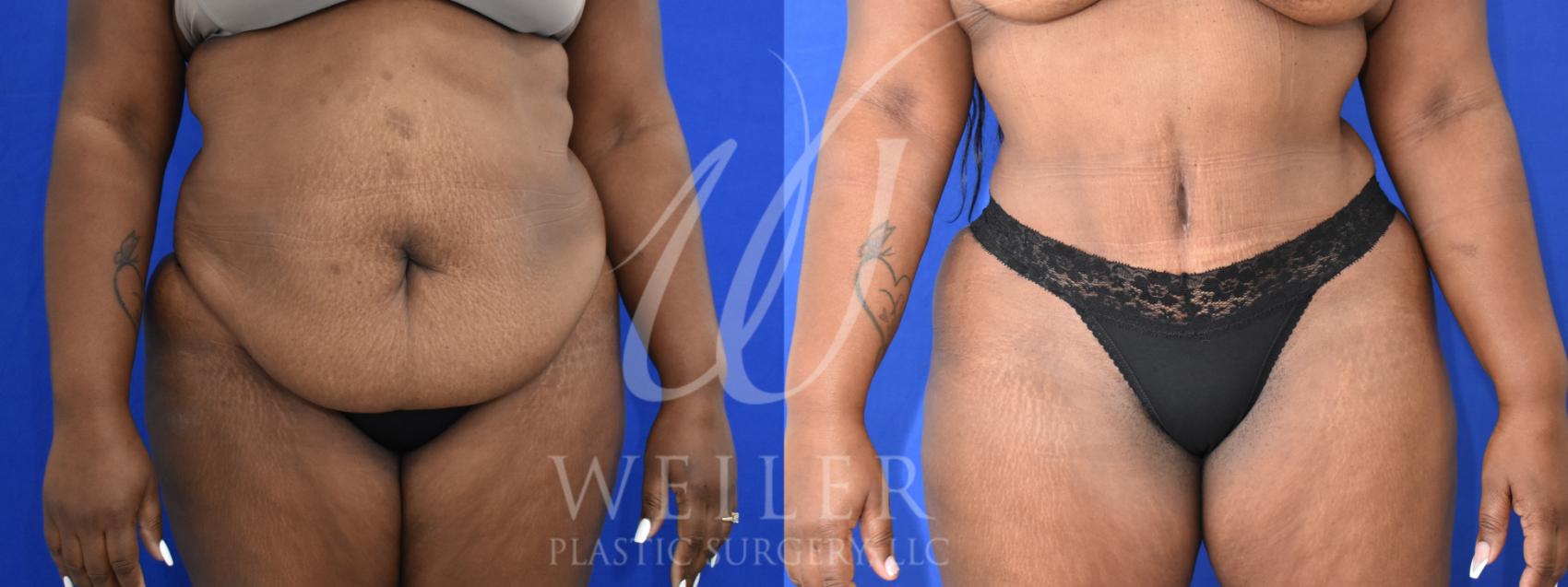 Before & After Tummy Tuck Case 961 Front View in Baton Rouge, New Orleans, & Lafayette, Louisiana