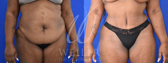Before & After Tummy Tuck Case 961 Front View in Baton Rouge, New Orleans, & Lafayette, Louisiana