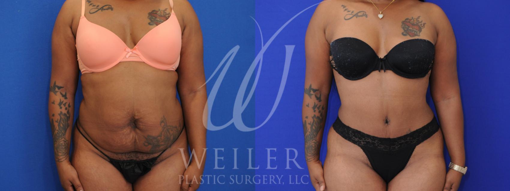 Before & After Tummy Tuck Case 980 Front View in Baton Rouge, Louisiana