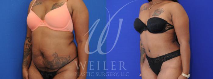 Before & After Tummy Tuck Case 980 Left Oblique View in Baton Rouge, Louisiana