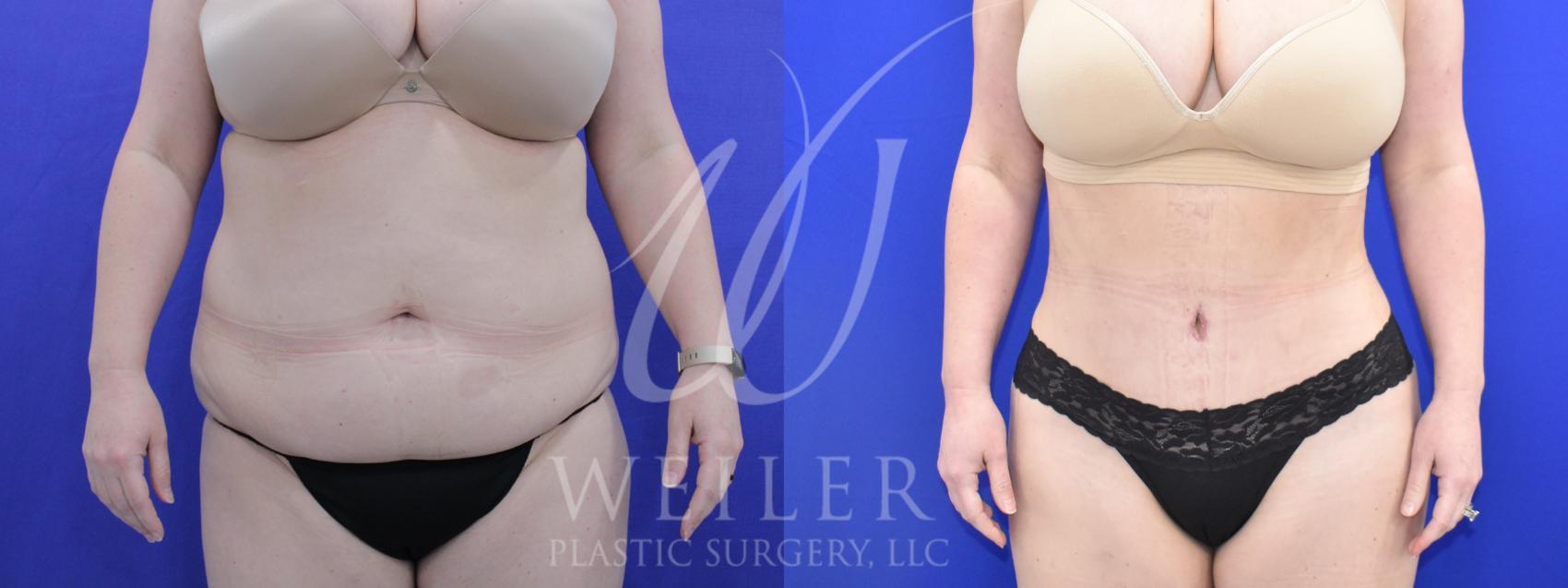 Before & After Tummy Tuck Case 993 Front View in Baton Rouge, New Orleans, & Lafayette, Louisiana