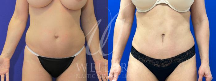 Before & After Tummy Tuck Case 994 Front View in Baton Rouge, New Orleans, & Lafayette, Louisiana