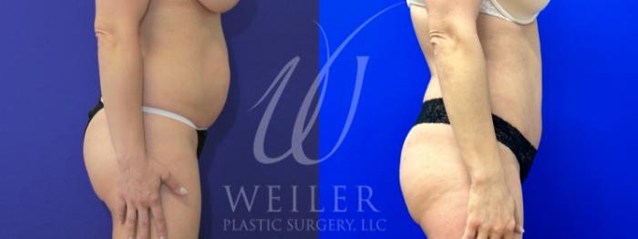 Before & After Tummy Tuck Case 994 Right Side View in Baton Rouge, New Orleans, & Lafayette, Louisiana