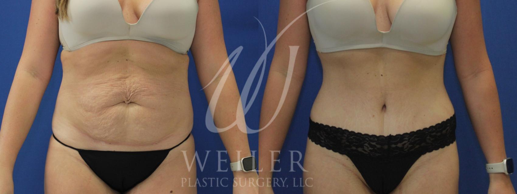 Before & After Tummy Tuck Case 996 Front View in Baton Rouge, Louisiana
