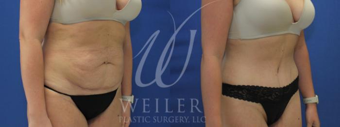 Before & After Tummy Tuck Case 996 Right Oblique View in Baton Rouge, New Orleans, & Lafayette, Louisiana