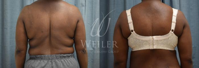 Patient before (left) and after (right) undergoing an upper body lift