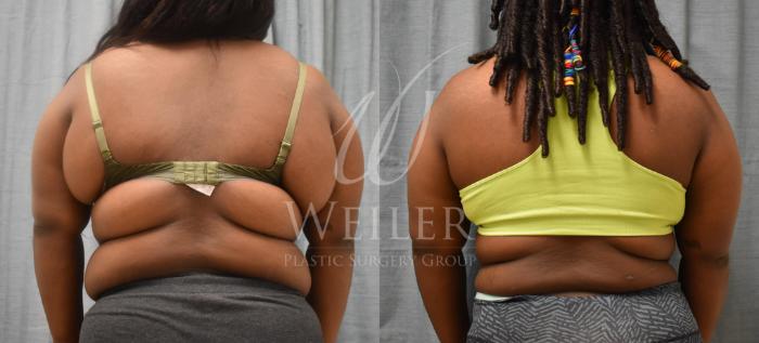 Before & After Upper Body Lift Case 384 View #1 View in Baton Rouge, New Orleans, & Lafayette, Louisiana