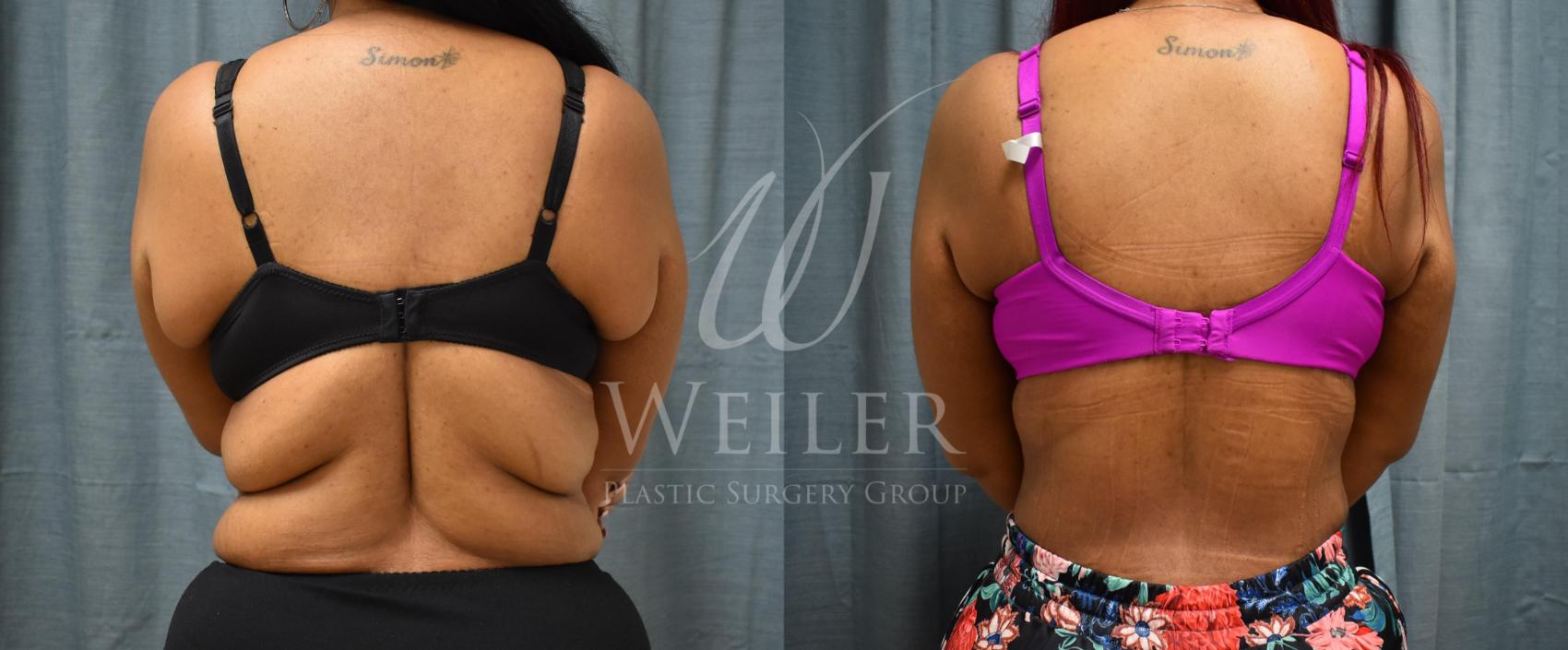 Before & After Upper Body Lift Case 385 View #1 View in Baton Rouge, Louisiana