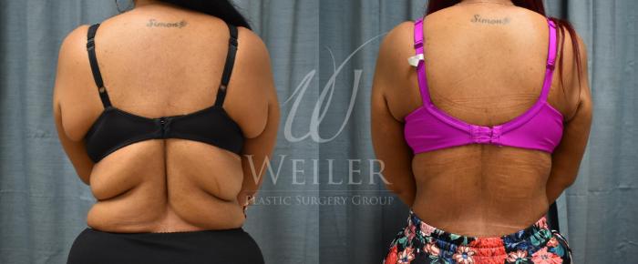 Before & After Upper Body Lift Case 385 View #1 View in Baton Rouge, New Orleans, & Lafayette, Louisiana