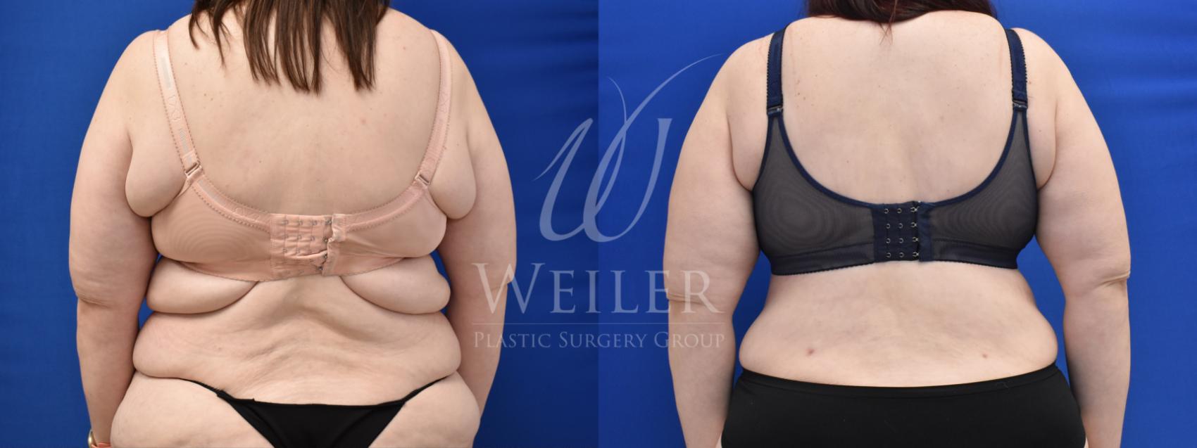 Before & After Upper Body Lift Case 754 Back View in Baton Rouge, Louisiana