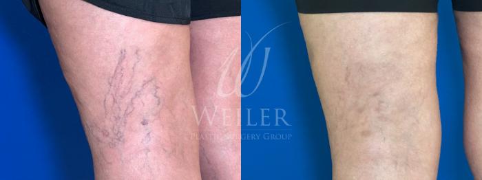 Sclerotherapy Vein Treatment